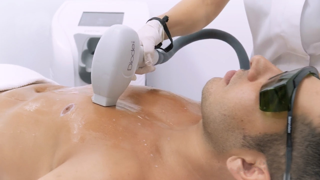 The Difference between IPL & Diode Laser Hair Removal – Oxford Laser  Aesthetics
